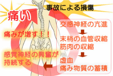 交通事故患者さんを悩ませる痛みのメカニズム